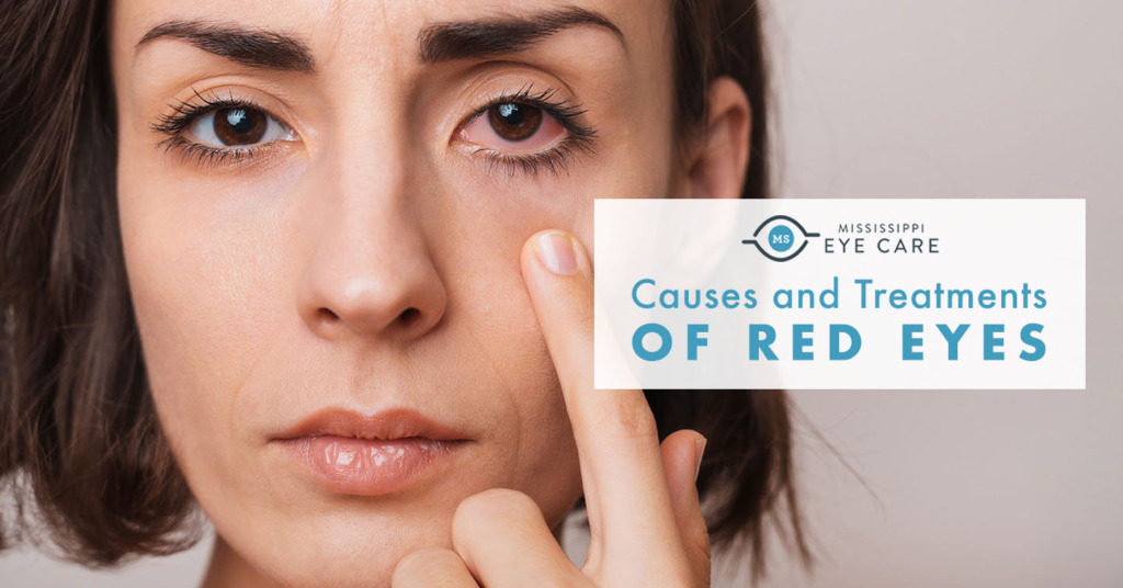 Causes And Treatments Of Red Eyes Mississippi Eye Care 3604