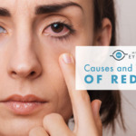 Causes and Treatments of Red Eyes
