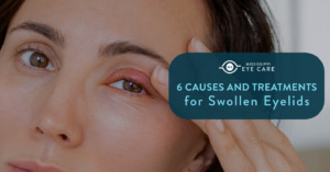Read more about the article 6 Causes and Treatments for Swollen Eyelids