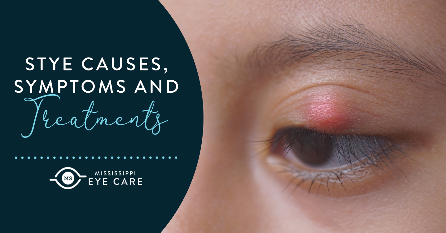 Read more about the article Stye Causes, Symptoms and Treatments