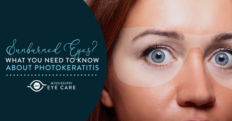 Sunburned Eyes? What You Need to Know About Photokeratitis